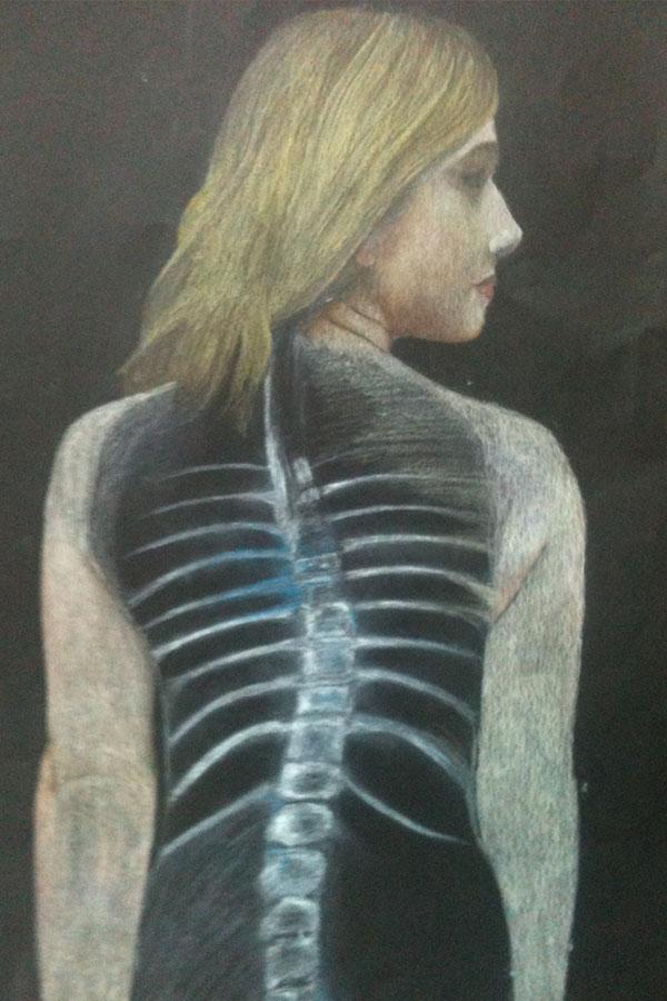 Madis finished piece depicting her scoliosis. 